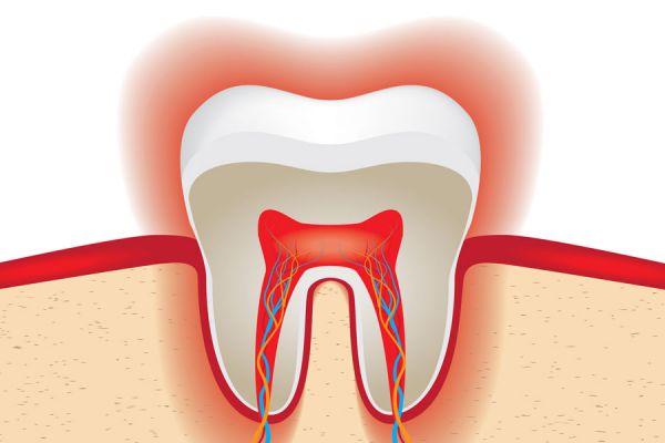 Cómo evitar el desgaste del esmalte de los dientes Cómo evitar el desgaste del esmalte de los dientes