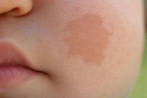 Cómo prevenir la piel atópica