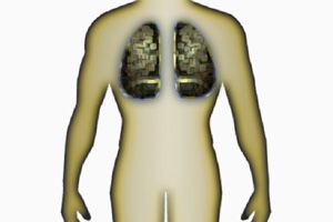El cáncer de pulmón