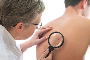 Prevención y tratamiento del melanoma