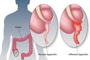 Síntomas de la apendicitis