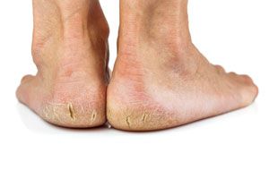 Remedios caseros para los pies secos y agrietados. Cómo curar los talones agrietados y secos. Cremas caseras para reparar los talones secos