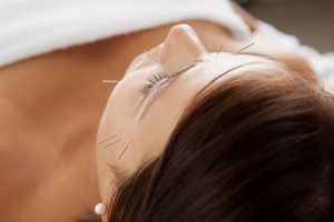 Cómo aliviar dolores con acupuntura. Beneficios de la acupuntura para aliviar dolores. Cómo calmar dolores con acupuntura